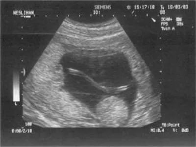 Fetal femur ölçümü normal değerleri